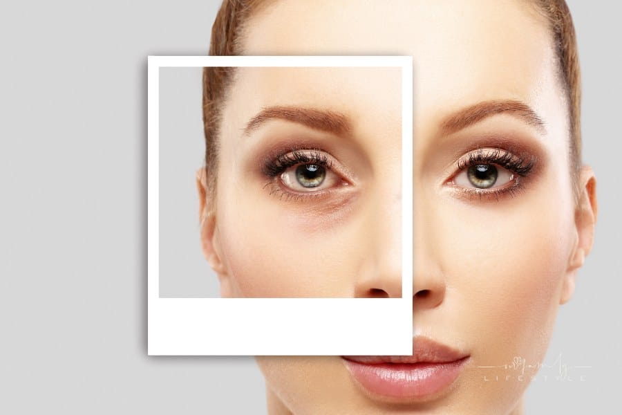 Lower Blepharoplasty. Upper blepharoplasty. plastic surgery concept.