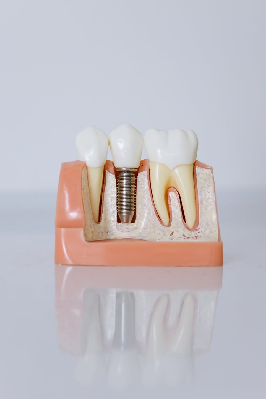 Detailed view of a dental implant model showcasing teeth and gum anatomy for dental education.