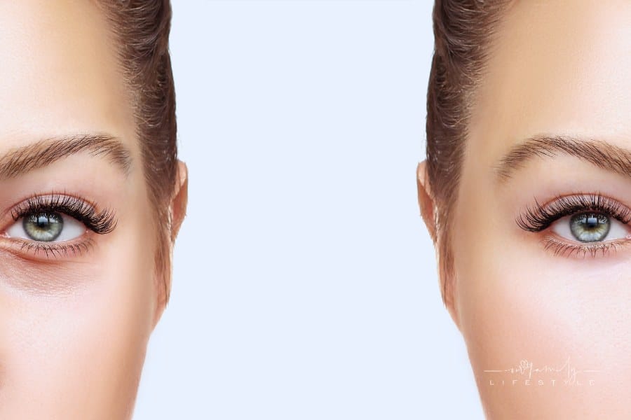 Face Comparison after Lower Blepharoplasty; eyelid surgery