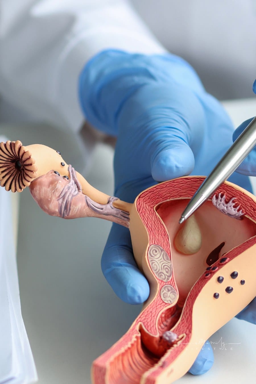 Gynecologist Doctor uses Pen on Plastic Model of Uterus and Ovaries to show Woman in Clinic