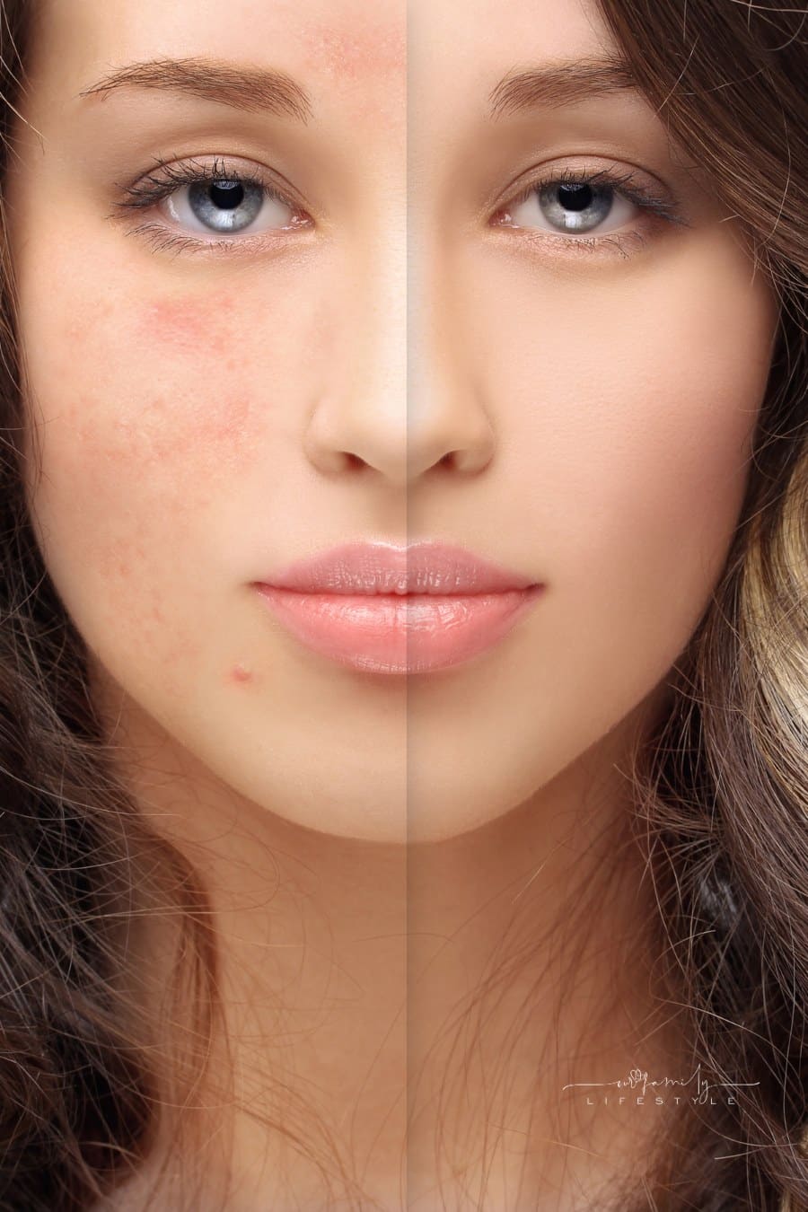 Post-Acne Marks /Treating Acne Scars. Acne Scar Removal