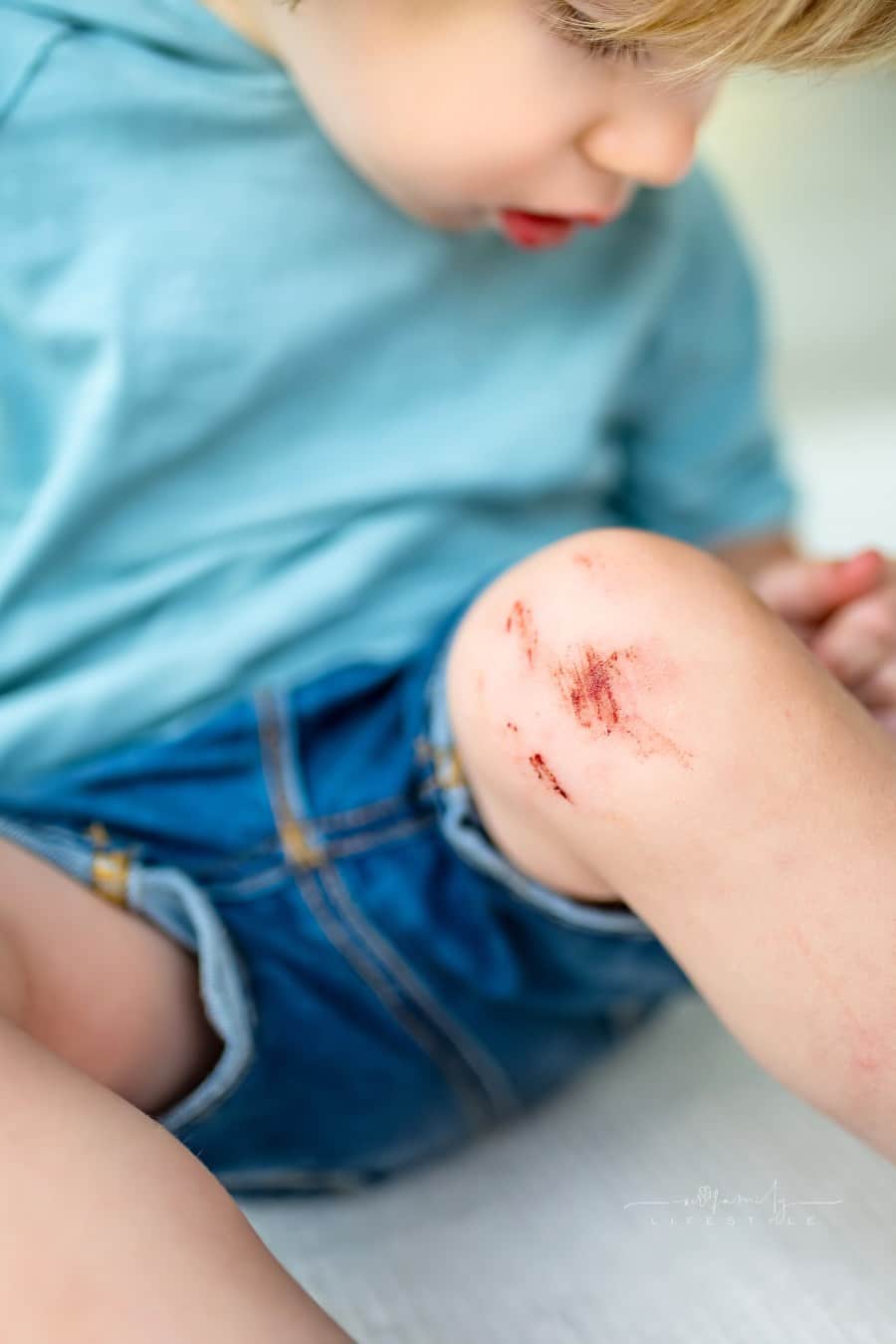 Toddler Boy with Scraped Knees. Knee Injury after an Accident.