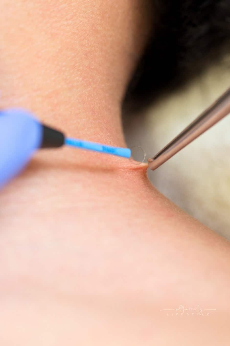 skin tag removal from neck