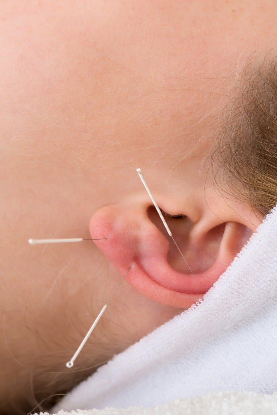 Close-up of acupuncture needles on an ear. Close-up of three acupuncture needles on the ear of a woman